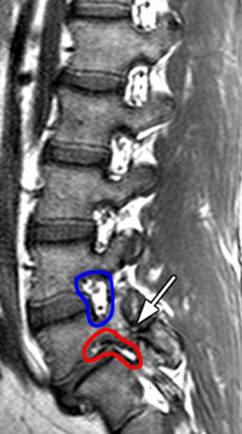 ESTENOSIS LUMBAR estenosis lumbar: