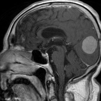 tumores-cerebrales-05